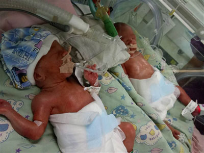premature twin babies