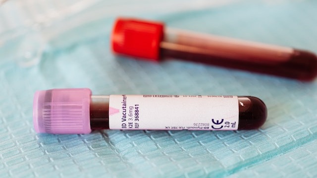 英媒：科学家开发出诊断阿尔茨海默病的血液检测法