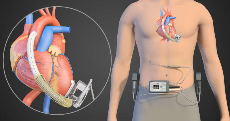 Chinese blood pump to be tested in US - Chinadaily.com.cn