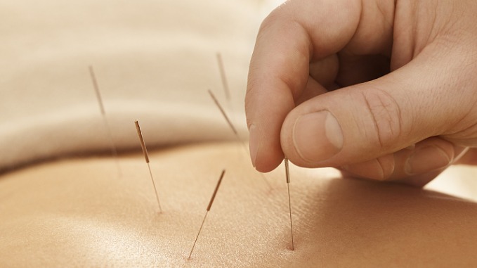 Chinese acupuncture reduces pain, anxiety in cancer surgery: Study - Vimarsana News