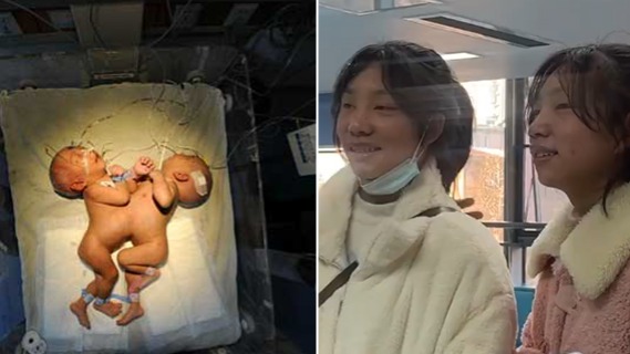 Separated conjoined twins living healthy lives - Vimarsana News